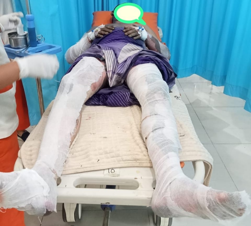 5 Hari Dirawat Medis, Korban Kebakaran di Banyumas Stabat Meninggal Dunia